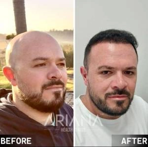 Hair transplant result case #1
