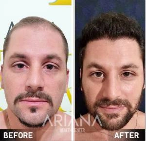 Hair transplant result case #2