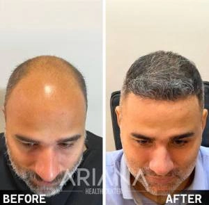 Hair transplant result case #3