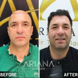 Hair transplant result case #4