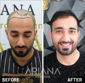 Hair transplant result case #5