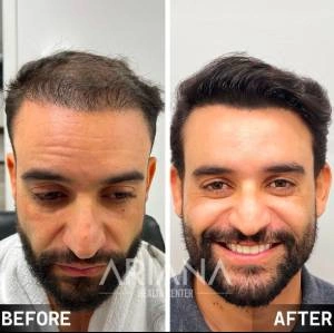 Hair transplant result case #6