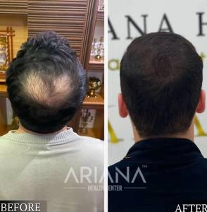 Hair transplant result case #7
