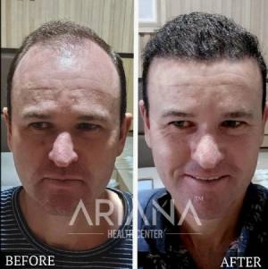Hair transplant result case #8